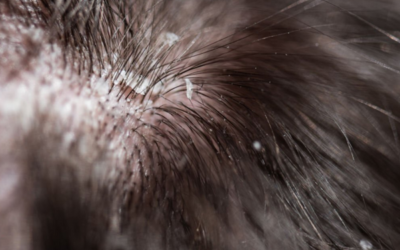How to Fix a Dry Scalp in the Winter