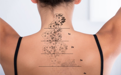 A Beginner’s Guide To Laser Tattoo Removal