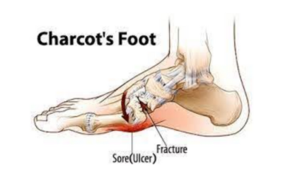 Charcot Joint Disease – Symptoms, Causes, Treatment