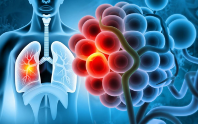 The Causes of Asthma According to Allergy Asthma Consultants