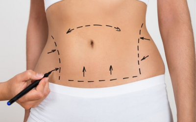 How Is The Recovery From Liposuction?