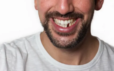 5 Ways to Replace Your Missing Tooth