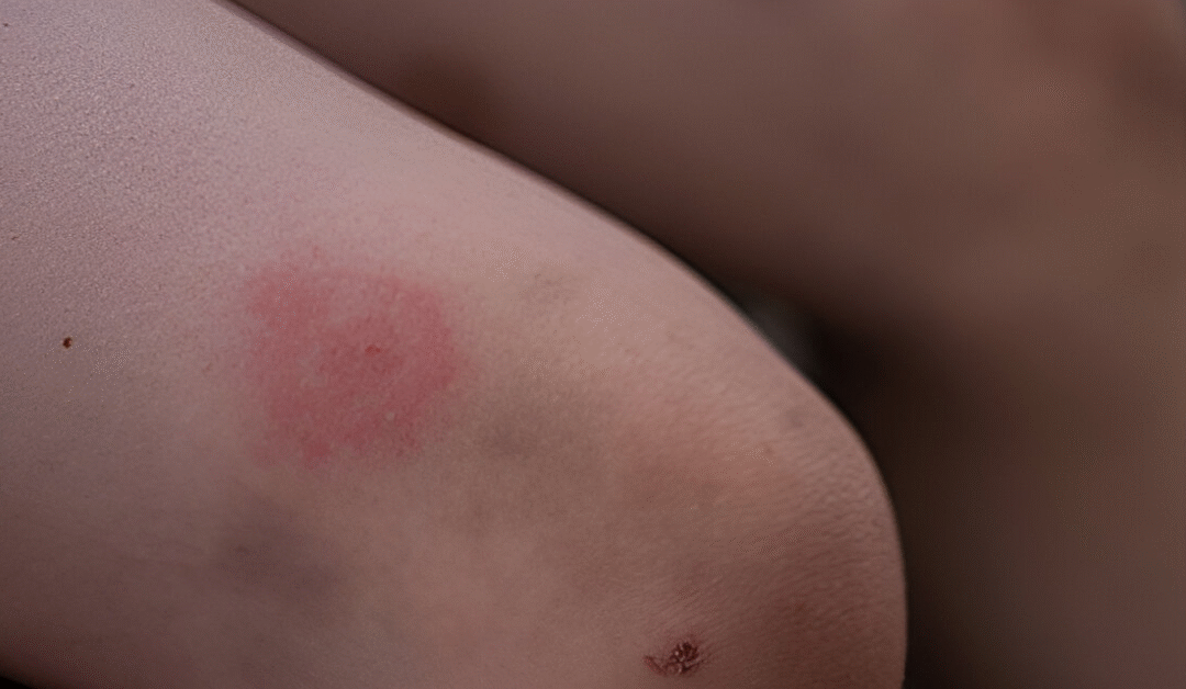 Living with Lyme Disease: Justin Timberlake’s Honest Revelation